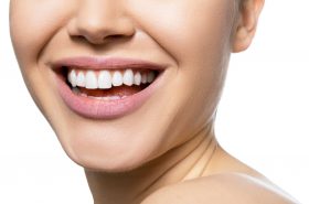 Što su ljuskice za zube?